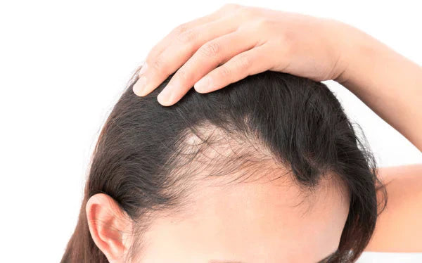 Top 3 Korean Haircare Products for Hair Loss in 2025
