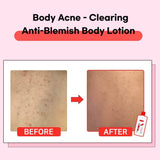TIA'M - Anti Blemish Body Lotion (Back & Chest) 200ml