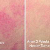 REJURAN Turnover Ampoule 30ml